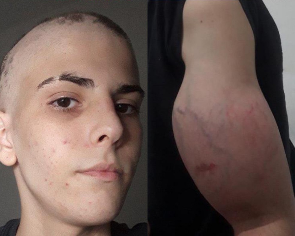 Adolescente amputará o braço direito na próxima semana, após iniciar tratamento contra um osteosarcoma — Foto: Arquivo Pessoal