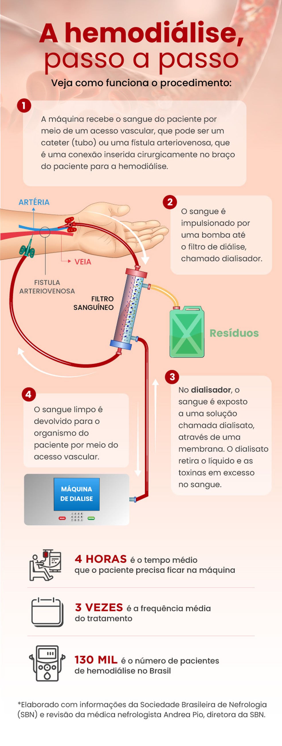 Infográfico mostra o passo a passo de uma hemodiálise — Foto: Divulgação