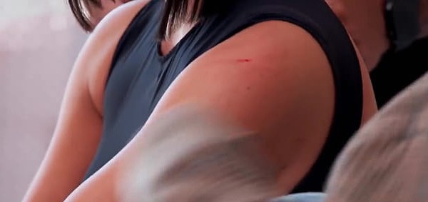 O braço de Kim Kardashian com a ferida decorrente do ataque da irmã Kourtney Kardashian (Foto: Instagram)