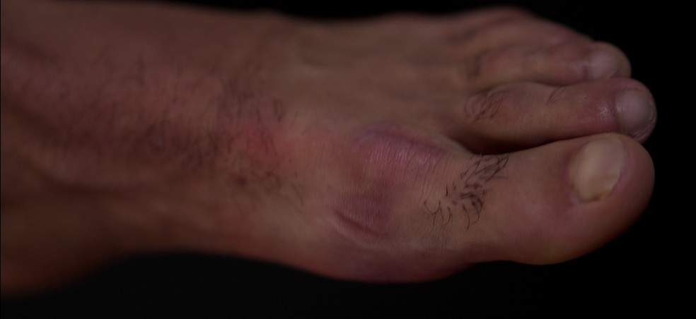 Fabr&iacute;cio Bruno, do Flamengo, teve les&atilde;o no ligamento do ded&atilde;o (h&aacute;lux) do p&eacute; esquerdo &mdash; Foto: TV Globo