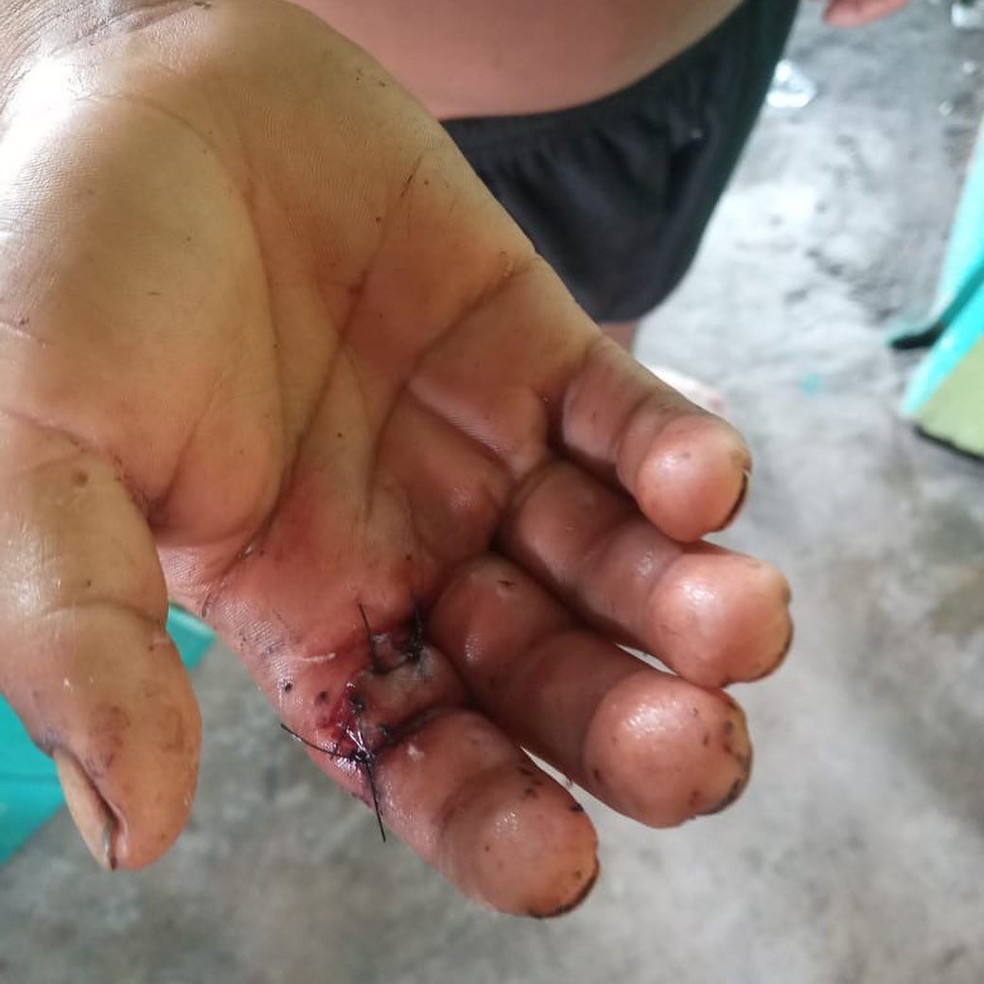 O jovem também teve ferimentos na mão, disse Condisi-YY — Foto: Divulgação/Condisi-YY