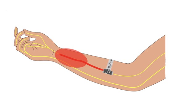 arm-implant-illustration.jpg