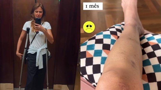 Luciana Gimenez mostra cicatrizes na perna um mês após acidente de ski