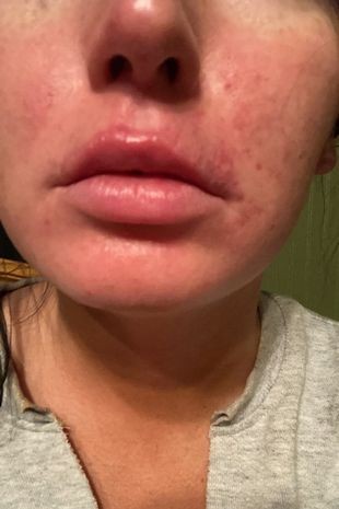 Chandra após recuperação dos lábios (Foto: Reprodução / Instagram, The Mirror)