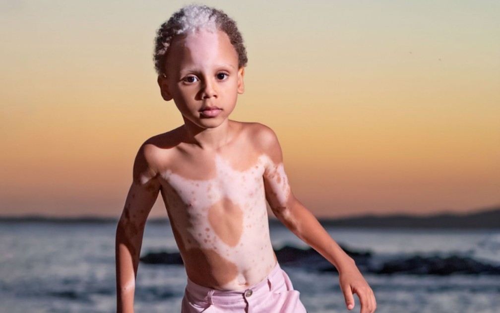 O baiano Samuel Purificação tem 5 anos e uma condição genética rara — Foto: Izabela Medina/Divulgação