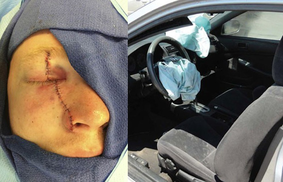 Corey Burdick, uma das vítimas dos airbags da Takata, ficou cego de um olho — Foto: Reuters