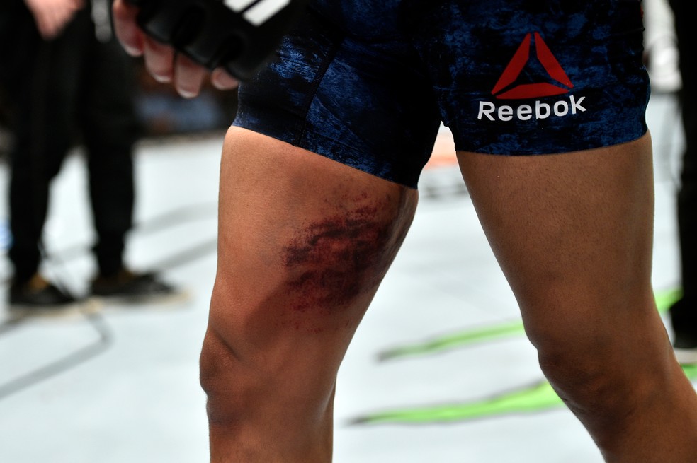 Coxa de Matthew Lopez castigada por Raphael Assunção ao longo de quase três rounds (Foto: Getty Images)