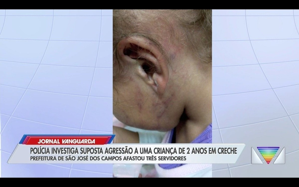 Die Polizei untersucht den Vorwurf der Körperverletzung gegen ein 2-jähriges Mädchen in einer Kindertagesstätte in São José dos Campos |  Tal und Region Paraíba