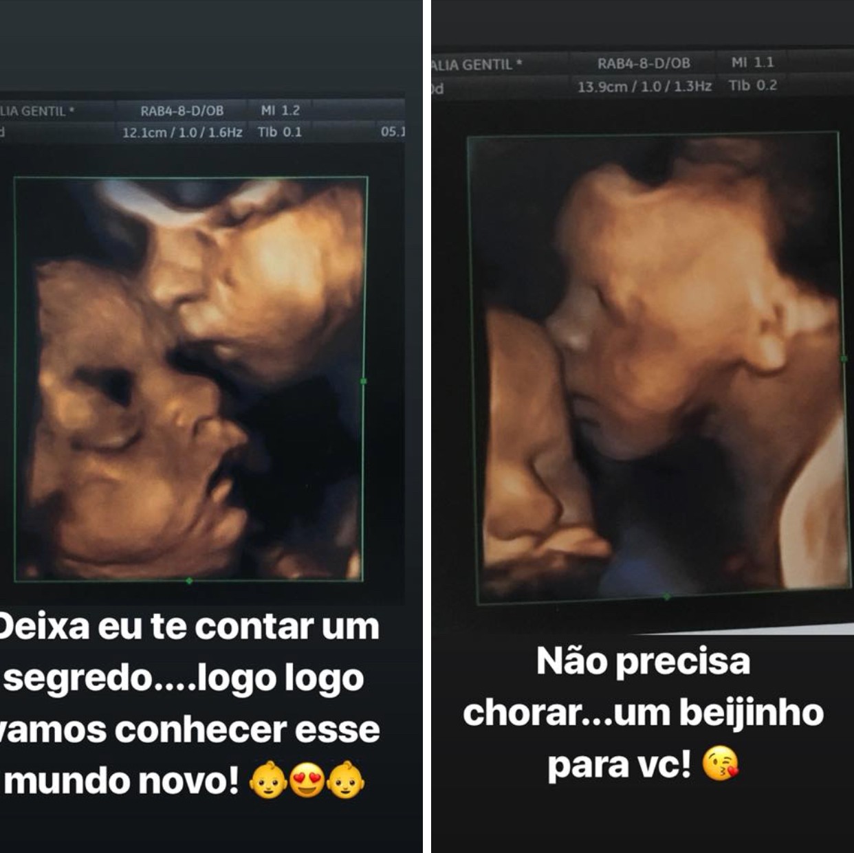 Gêmeas no ultrassom (Foto: Reprodução Instagram)