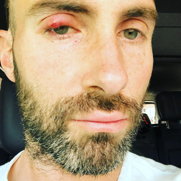 Adam Levine faz selfie com conjuntivite, mas fãs continuam a elogiar (Foto: Reprodução/Instagram)