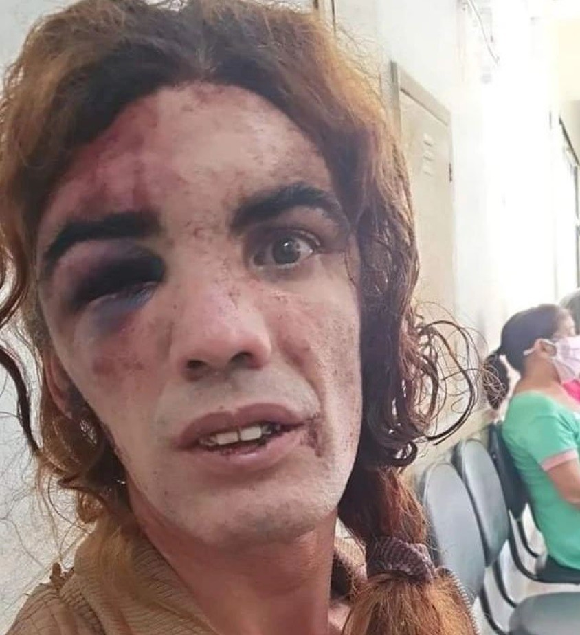 Mulher trans sofre trauma no rosto após ser agredida por homem em Sobradinho, no DF