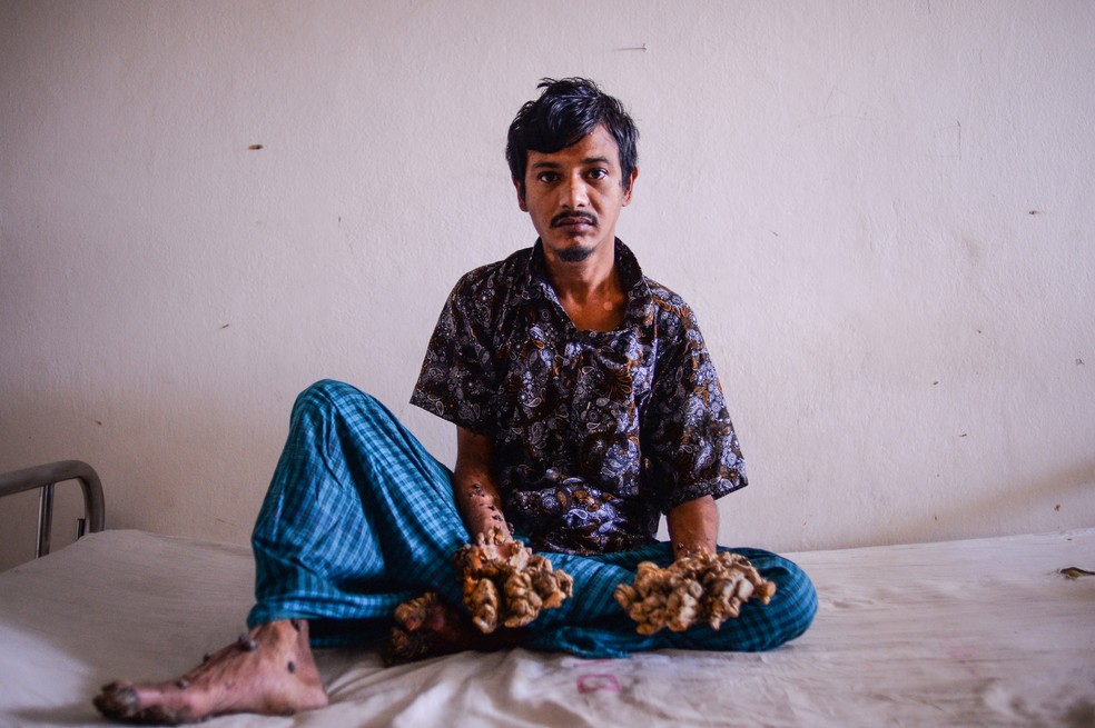 Abul Bajandar tem 28 anos e sofre de epidermodisplasia verrucosa, uma condição genética muito rara — Foto: Munir UZ ZAMAN / AFP