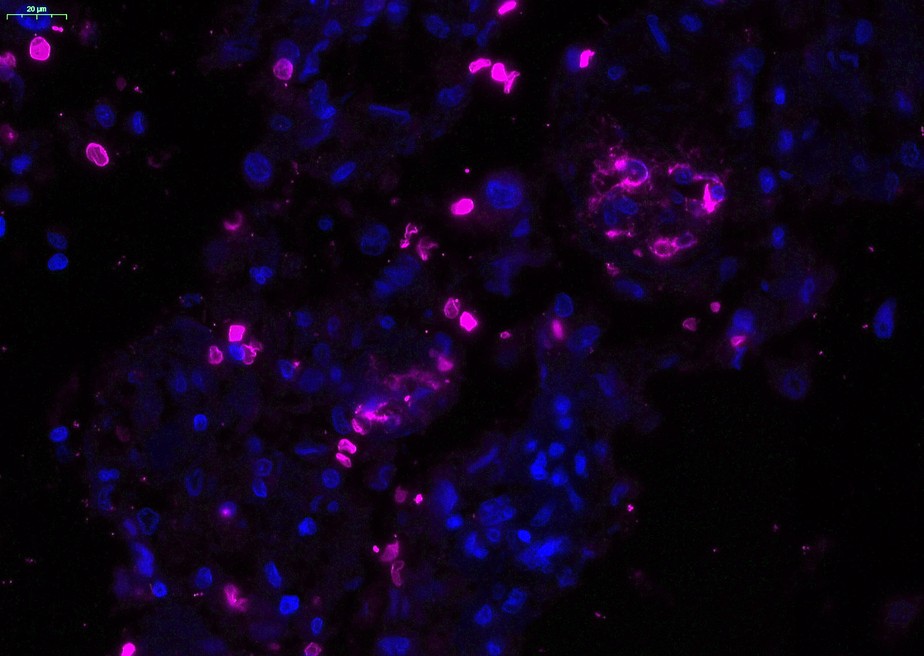 Células fúngicas e imunes no câncer de mama humano