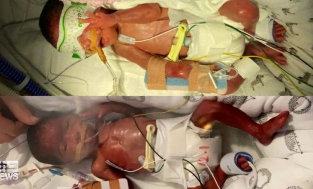Tilila e Leylani nasceram prematuras e estão internadas (Foto: Reprodução/9news)