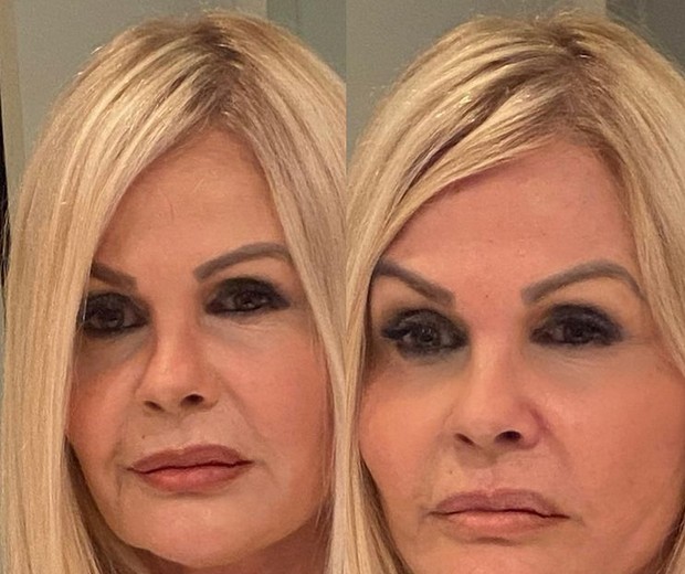 Monique Evans mostra resultado de harmonização facial (Foto: Reprodução/Instagram)