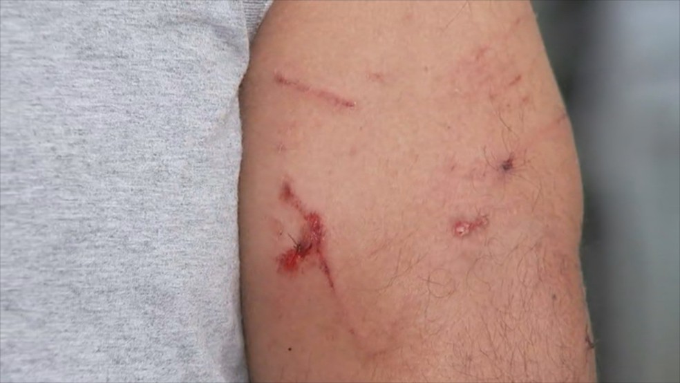 Homem sofreu ferimentos após ser atacado por cachorro em Fernandópolis  — Foto: Reprodução/TV TEM 