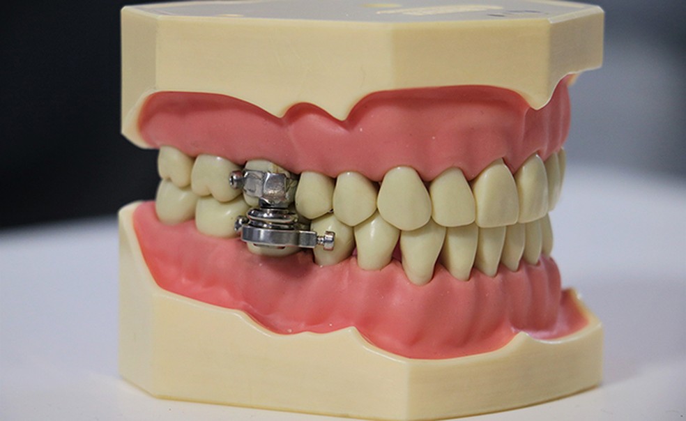 Dispositivo magnético limita a abertura da boca a apenas 2 milímetros — Foto: Universidade de Otago