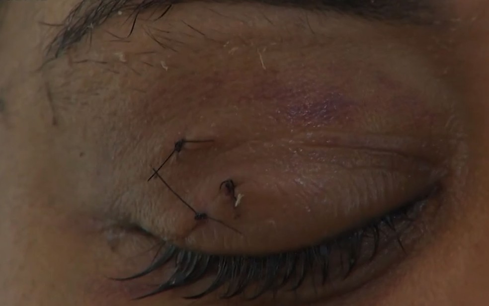 Isabela tem pontos até no olho, onde foi golpeada com faca na Bahia — Foto: Reprodução/TV Bahia
