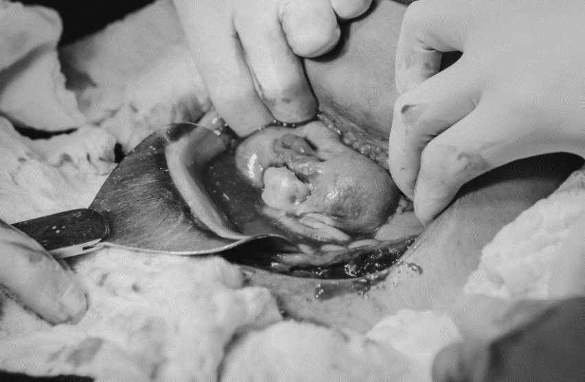 Rosto de Laura foi fotografado ainda dentro da barriga da mãe durante cesárea (Foto: Bruna Costa)