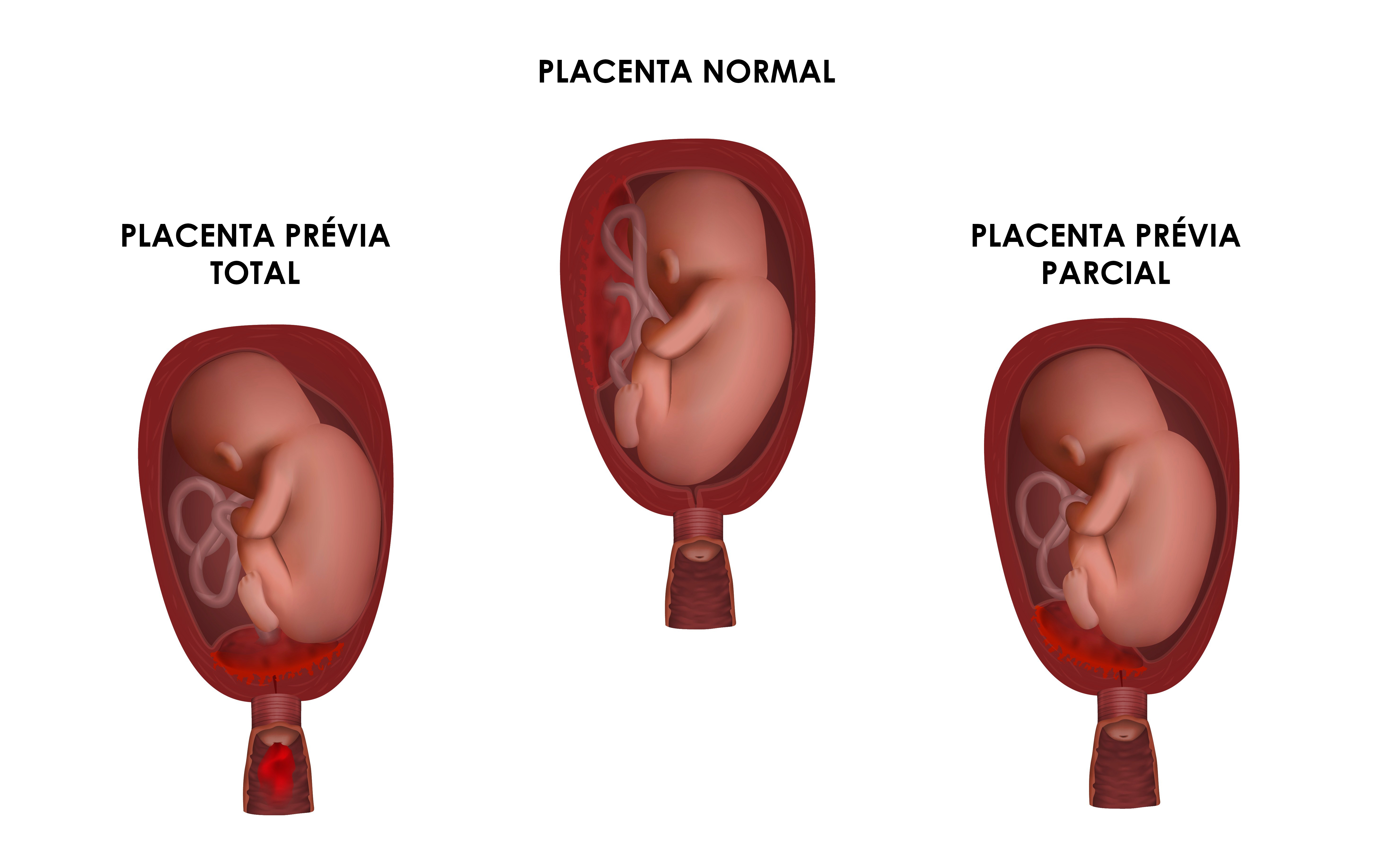 Tipos de placenta prévia (Foto: Veronica Zakharova / Getty Images)
