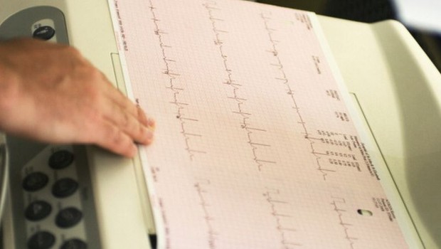 O eletrocardiograma é um exame que mede a atividade elétrica do coração. Os resultados vêm na forma de curvas, como na imagem, e são interpretados pelos médicos (Foto: Getty Images via BBC)