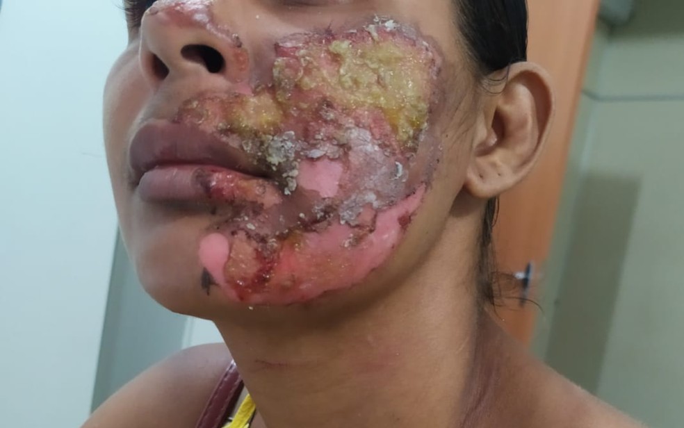 Homem é preso suspeito de tentativa de feminicído após jogar panela com óleo quente no rosto da companheira na BA — Foto: Reprodução/Site Itamaraju Notícias