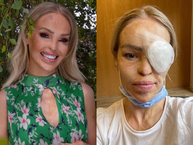 Katie Piper faz cirurgia no olho (Foto: Reprodução/Instagram)