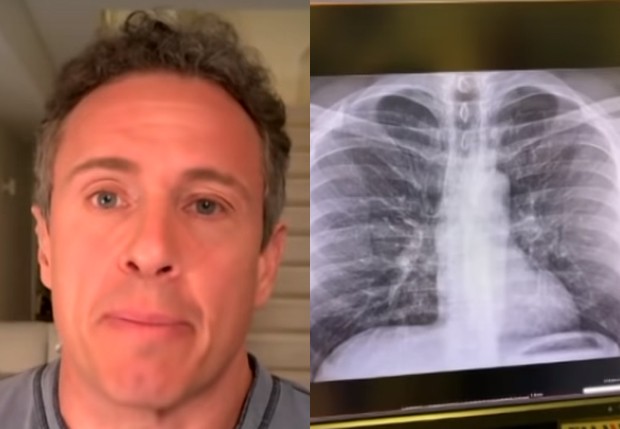 Com Covid-19, Chris Cuomo, da CNN, mostra raio X dos pulmões (Foto: Reprodução/CNN)