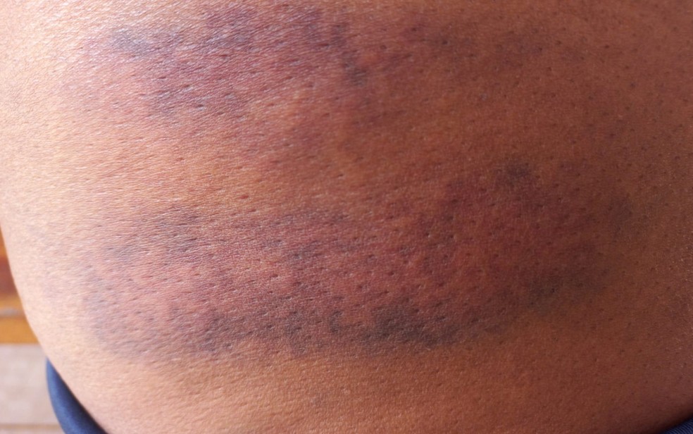 Golpe de facão na perna da passageira deixou hematoma — Foto: Reprodução/Arquivo pessoal
