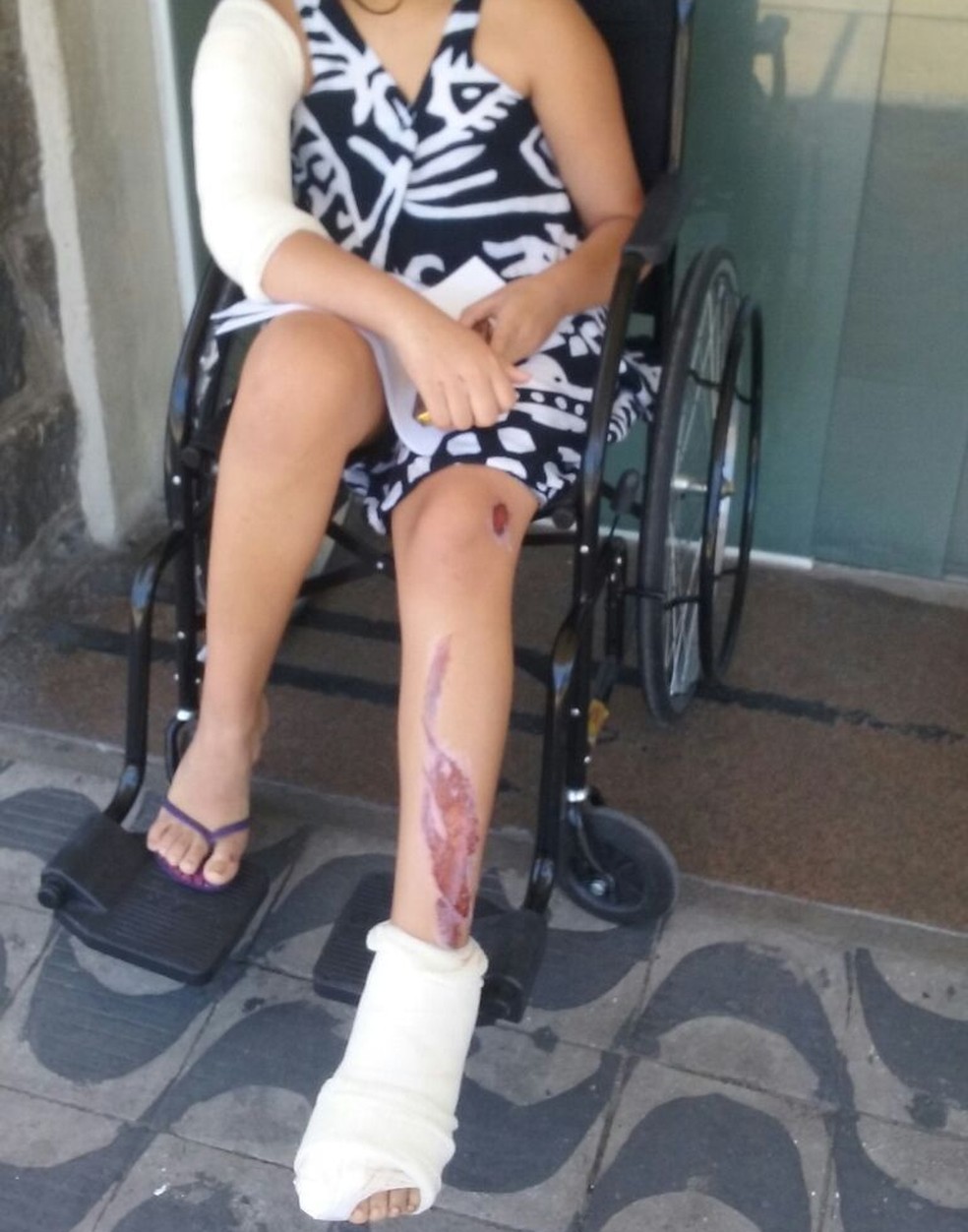 Yasmin de 10 anos teve ferimentos nas pernas e quebrou o brao aps ser atropelada por um carro quando passeava de moto com a tia Priscila em Santos Foto G1