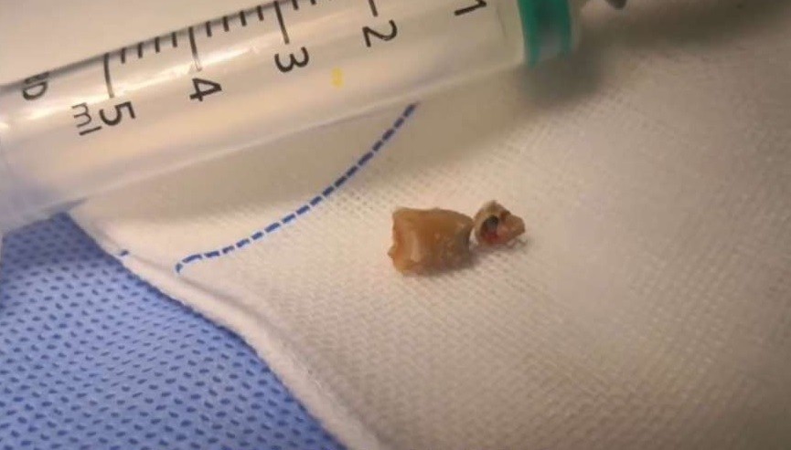 Dente foi extraído do interior do nariz de paciente (Foto: Divulgação)