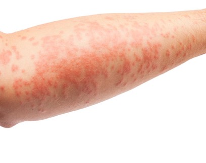 Dermatite atópica: 41% dos brasileiros desconhecem doença de pele comum