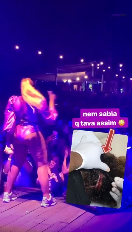 Gaby Amarantos cai do palco e mostra corte na cabeça (Foto: reprodução/ instagram)