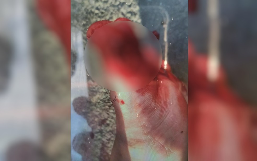 Turista perde parte do dedo por causa de ataque de piranha em lago de Caldas Novas, Goiás — Foto: Reprodução/TV Anhanguera