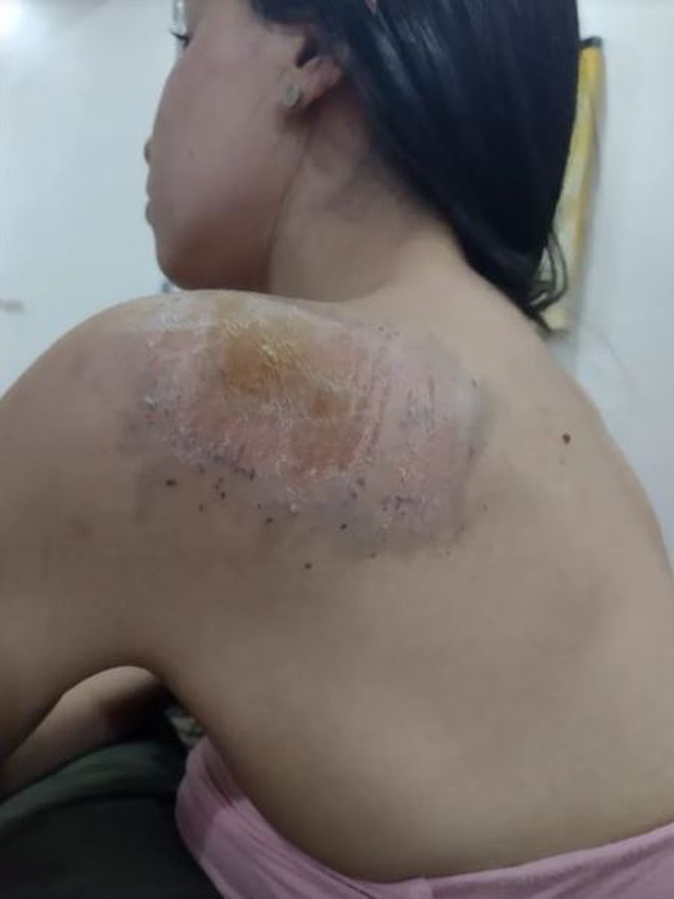 Andressa ficou com ralados pelo corpo após cair da bicicleta, em Palmas — Foto: Arquivo pessoal