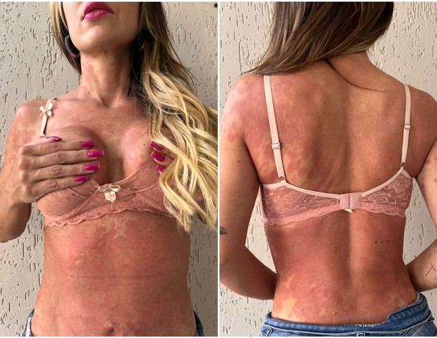 Letícia Santiago mostra manchas pelo corpo (Foto: Arquivo pessoal)