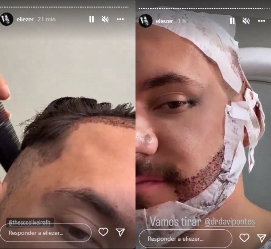 Eliezer mostra resultado de cirurgia de transplante de cabelo e barba (Foto: Reprodução/Instagram)