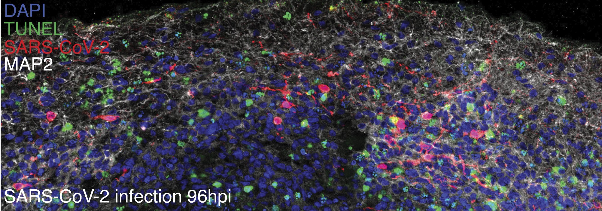 Imagem de um organoide do cérebro humano mostra inúmeras células morrendo (verdes) ao redor dos neurônios (cinza) que foram infectados por Sars-CoV-2 (vermelho). (Foto: 2021 Song et al. Originally published in Journal of Experimental Medicine)