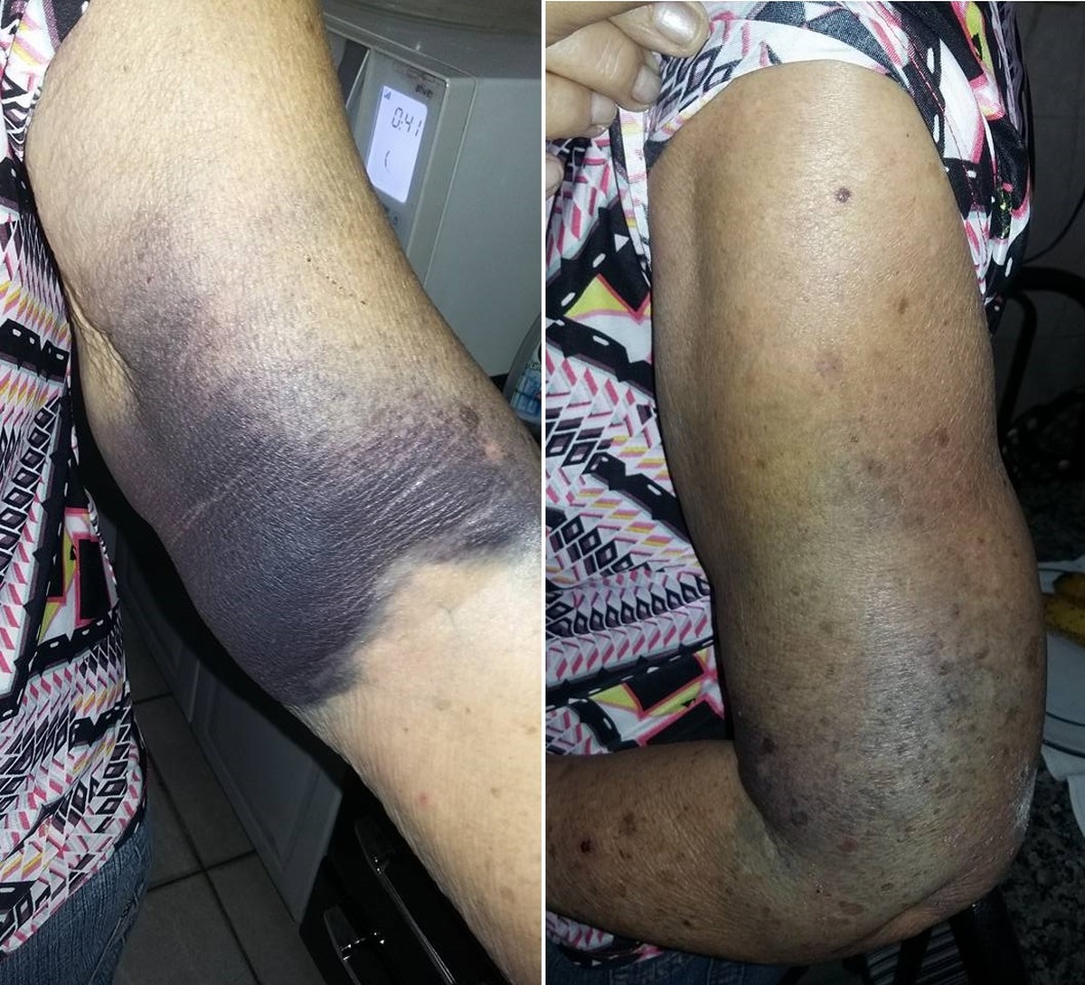 Idosa fica com hematomas no braço após tomar vacina em ...