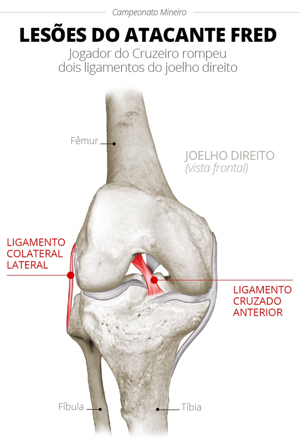 A lesão no joelho direito de Fred (Foto: Infoesporte)