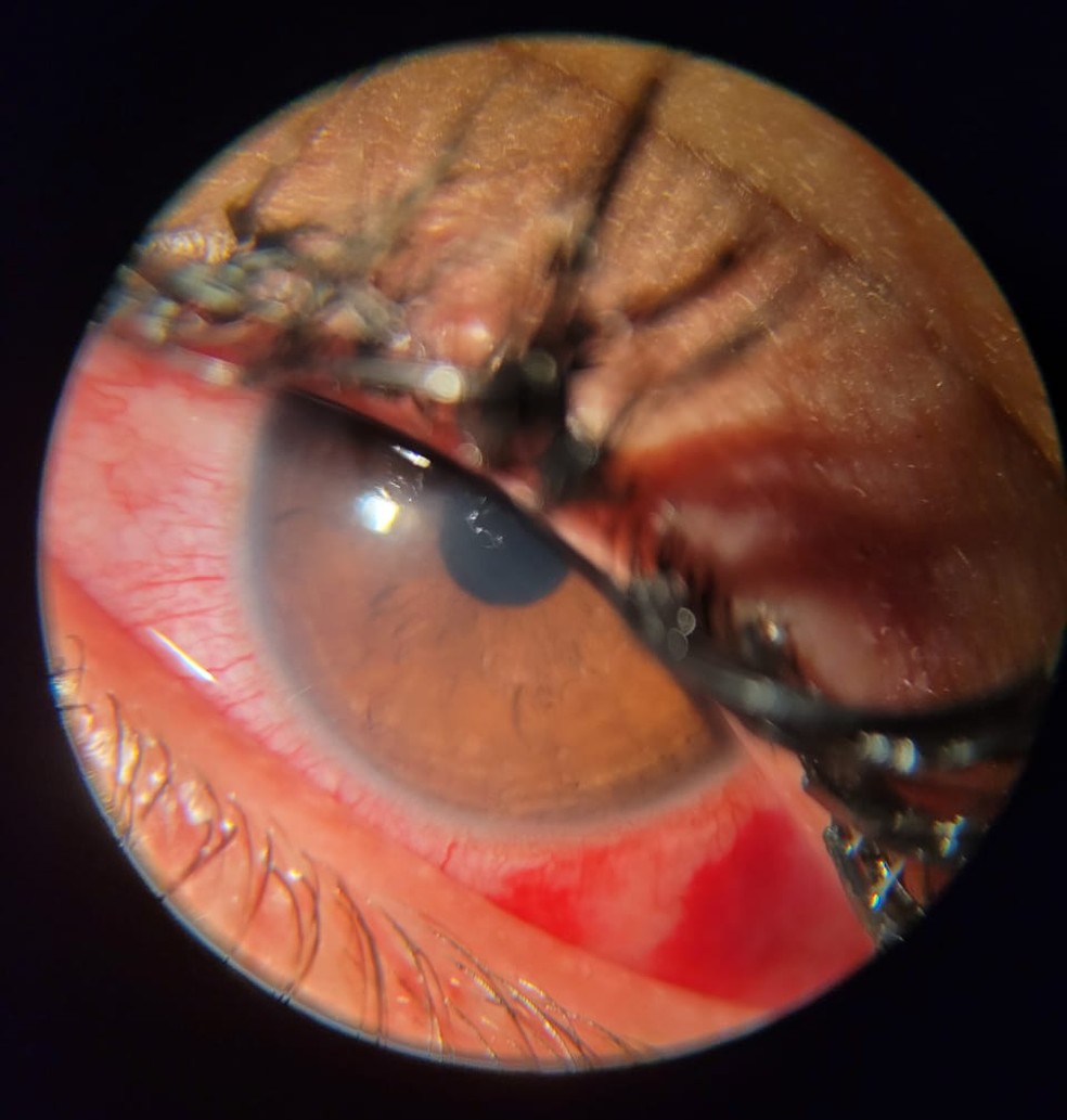 Inflamação nas córneas de paciente que teve olhos atingidos por pomada capilar — Foto: Gerson Nóbrega/Filipe Nóbrega/Analivia Oliveira/Divulgação