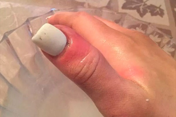 A infecção no dedo da modelo Karolina Jasko (Foto: Reprodução Facebook)