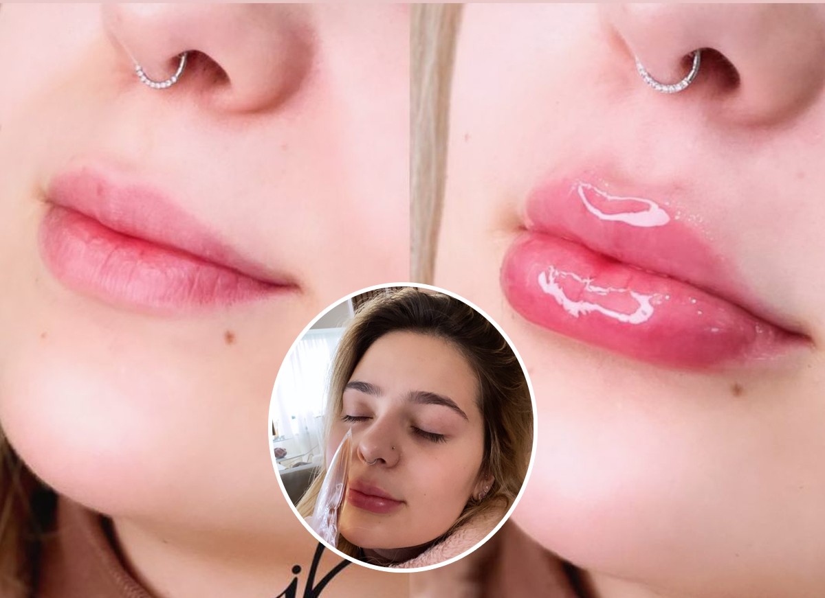Viih Tube faz preenchimento labial e mostra antes e depois na web (Foto: Reprodução / Instagram)
