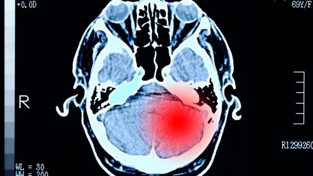 'Os tumores cerebrais são um desafio porque as possibilidades de tratamento e o prognóstico de recuperação são extremamente ruins', diz especialista (Foto: GETTY IMAGES (via BBC))