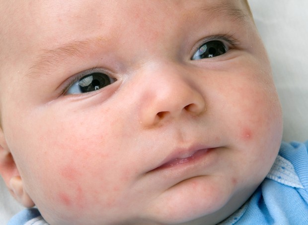 Bebê pode ter acne neonatal no rosto (Foto: Thinkstock)