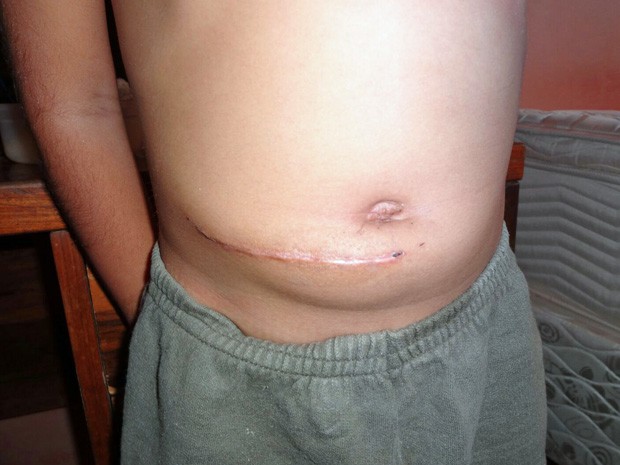 Cicatriz deixada após duas cirurgias (Foto: Elisangela Pereira / Arquivo Pessoal)