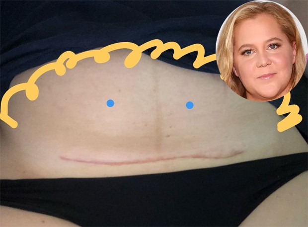 Amy Schumer mostra cicatriz da cesariana (Foto: Reprodução/Instagram e Getty Images)