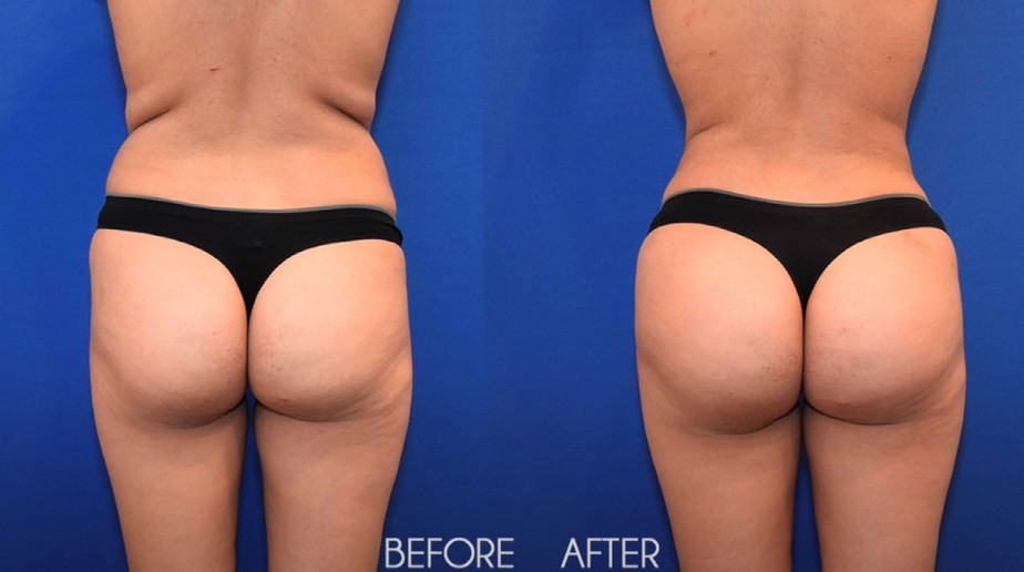 Imagem mostra antes e depois de cirurgia do 'bumbum brasileiro' feita nos EUA
