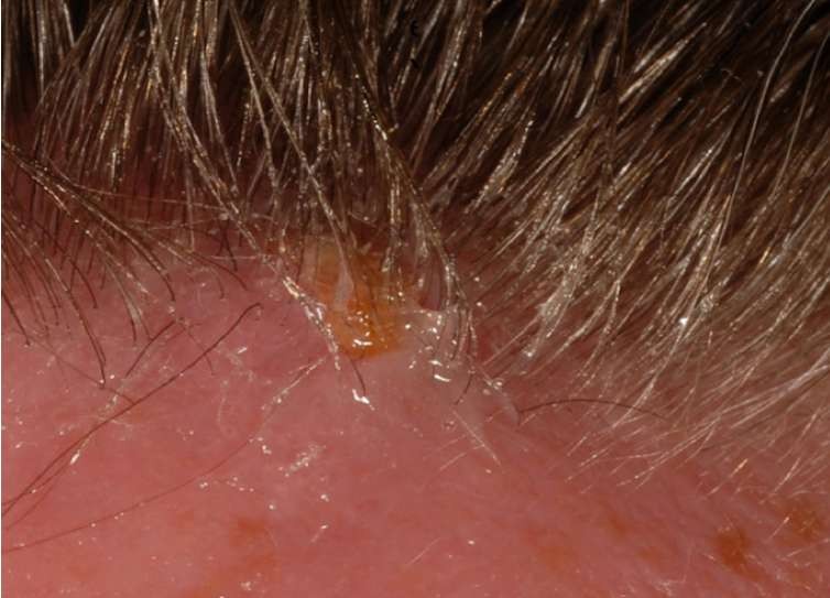 Larvas de inseto se instalaram no interior do rosto de paciente  (Foto: Divulgação/ BMJ Case Reports)
