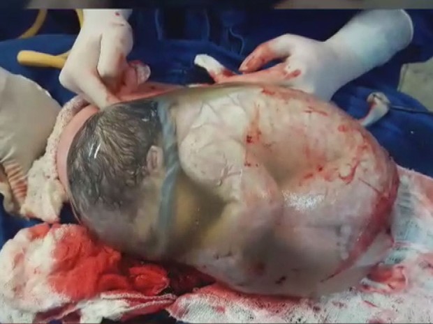 Bebê gêmeo nasceu envolto no saco amniótico durante cesariana em Barretos, SP (Foto: Gisele Aparecida Correia da Silva/Arquivo pessoal)